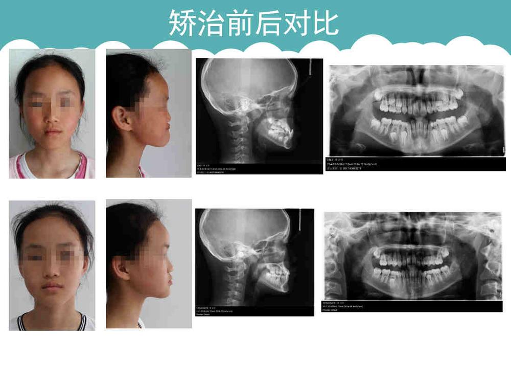 l 患者:女  10岁   l 主诉:地包天,要求矫谜 .